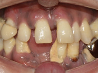 장OO님 상악전치하악전체(전).jpg